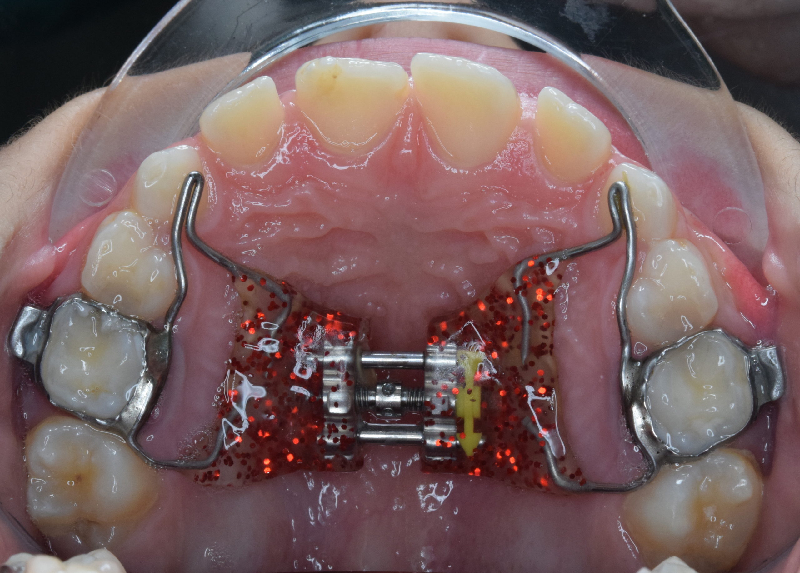 SEN Blu ortodontico per apparecchi ortodontici 